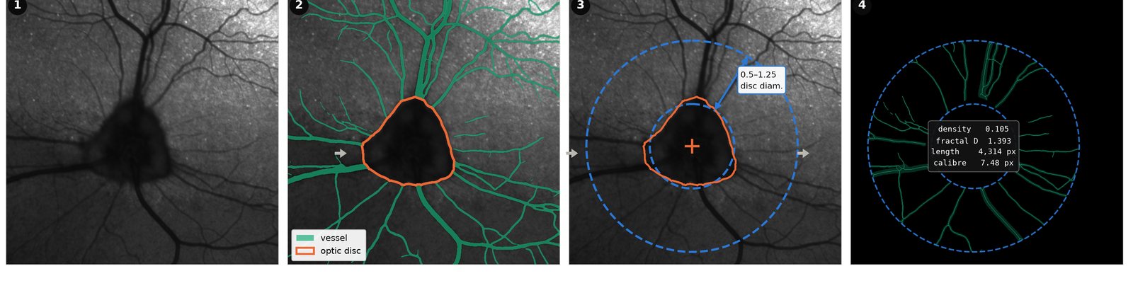 Four panels of a retinal imaging pipeline: an acquired infrared en-face frame, the same frame with vessels and the optic disc segmented, a region of interest anchored to the disc in disc-diameter units, and the extracted vascular skeleton with density, fractal dimension, length and calibre measurements.