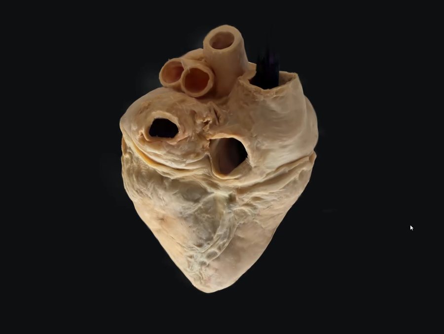 A three-dimensional reconstruction of a gross heart specimen rendered against a black background, with great vessels visible at the top.