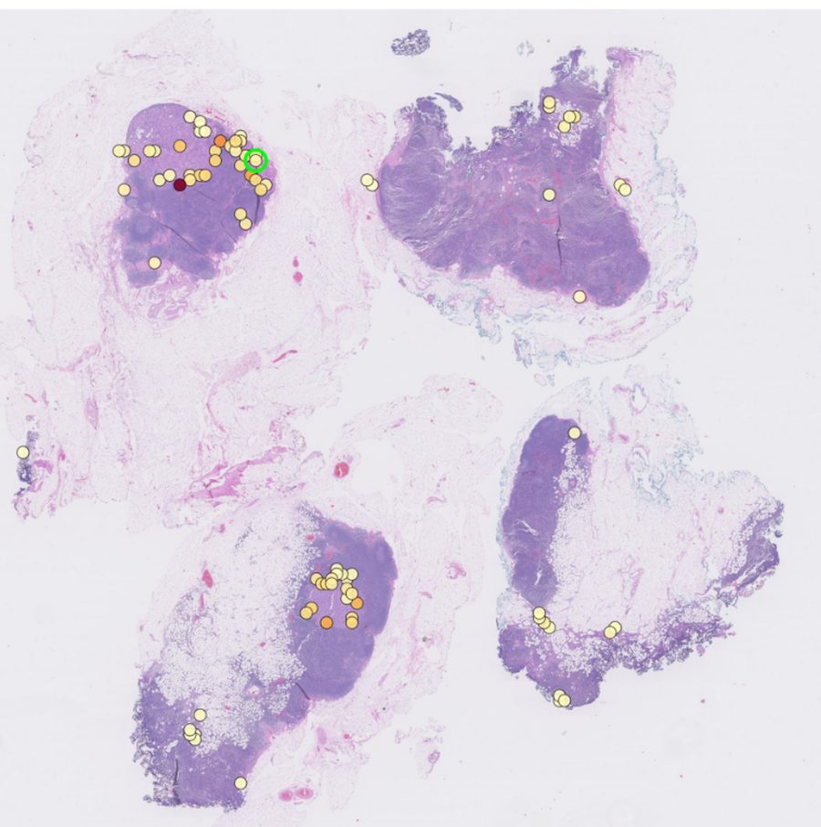Four pale lavender tissue sections on a whole-slide image, scattered with small yellow and orange dots marking where a classifier placed attention, densest over the darker tumour regions.